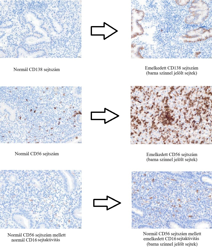 uNK immun teszt – CD138, CD56 és CD16 sejtek immunhisztokémiai festése: normál és emelkedett sejtszám összehasonlítása