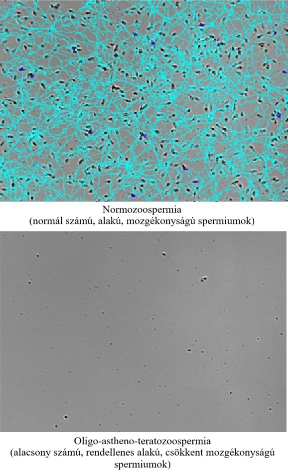 Spermatogram (SPG) AI-elemzés – normozoospermia és oligo-astheno-teratozoospermia összehasonlítása